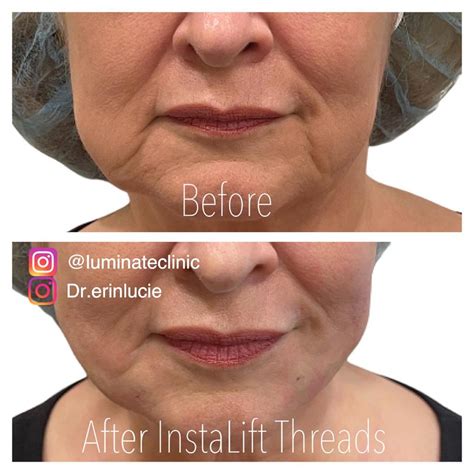 Thread Lifts Near Me | PDO Thread Lift in Tulsa, OK | Luminate