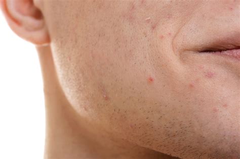 Acne Scarring - Pennsylvania Centre for Dermatology