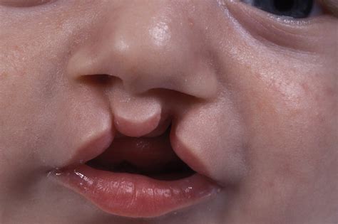 Cleft lip and palate - NHS