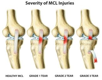 Common Questions About MCL Knee Sprains - Beacon Orthopaedics