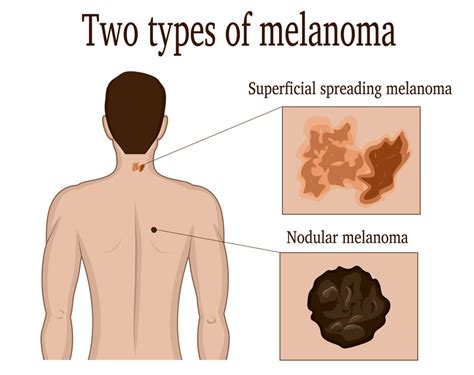 What Is Nodular Melanoma? - University Health News