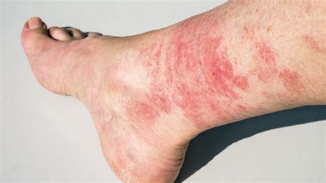 Rash on Legs: Causes and Treatment