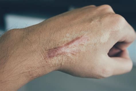 Scar tissue: Causes, prevention, and treatment