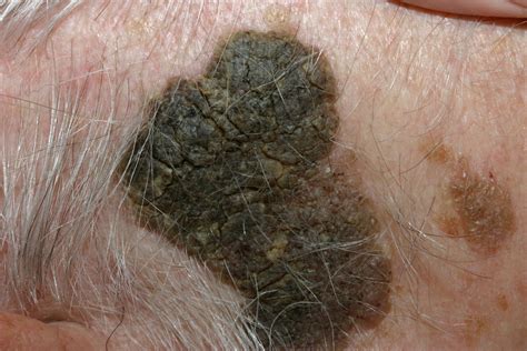 Home Remes For Seborrheic Keratosis - Homemade Ftempo