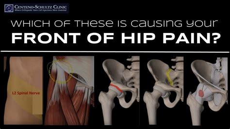 5 Possible Causes for Pain at the Front of the Hip | Stem Cell Blog