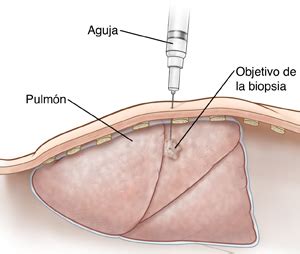 Krames Online - Biopsia de pulmón guiada por TC