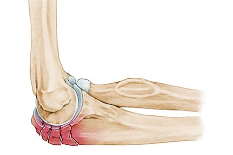 Olecranon fracture