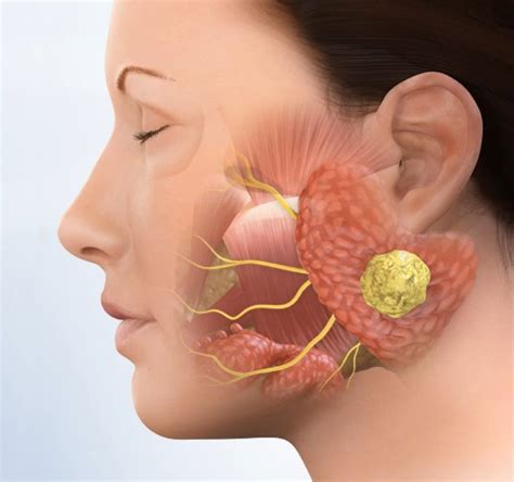 After Parotid Gland Surgery - ENT Clinic