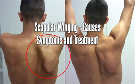 Scapular Winging - Causes Symptoms and Treatment