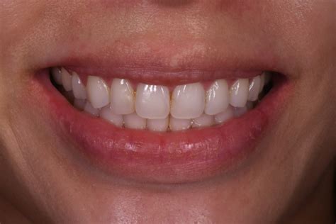 Dentist Before After Gallery, Family and Cosmetic Dentistry in 92128