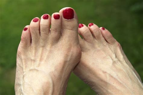 Rheumatoid Arthritis Feet