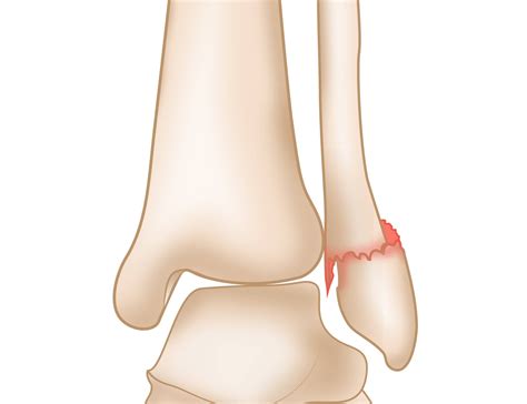 Lateral Malleolus Fracture