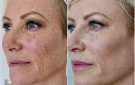 BBL® Laser Skin Rejuvenation Before and After Photo Gallery | Toronto ...