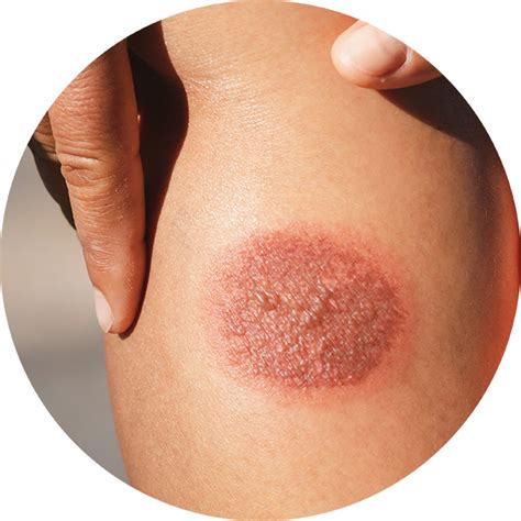 Psoriasis – Vedant Ayurved