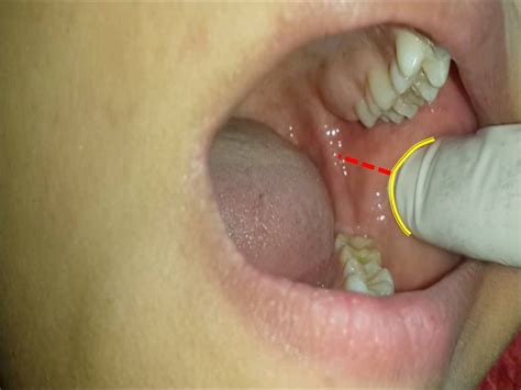 Inferior Alveolar Nerve Block - slidesharetrick