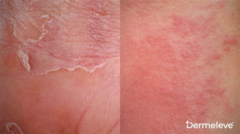 What’s The Difference Between Eczema and Psoriasis? – Dermeleve®