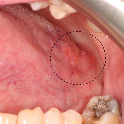 a GCF of the mandibular facial gingiva presenting as a pale pink ...