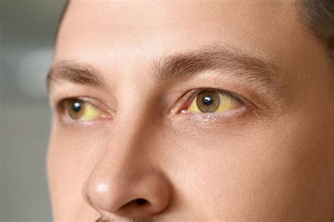 Alcoholic Eyes: Symptoms, Treatment & Prevention