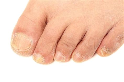 Do your toenails gross you out? - Just Naturally Healthy