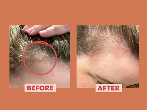 Scalp Psoriasis Pictures Symptoms And Treatment - vrogue.co