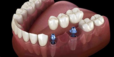 What do dental implants look like - Dental News Network