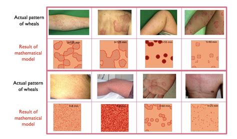 Studying the geometry of a common skin disease