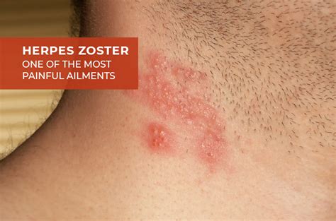 HERPES ZOSTER – ONE OF THE MOST PAINFUL AILMENTS…