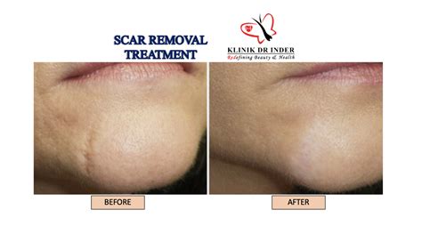 Laser Scar Removal - Scar Removal Treatment - Aesthetic Clinic