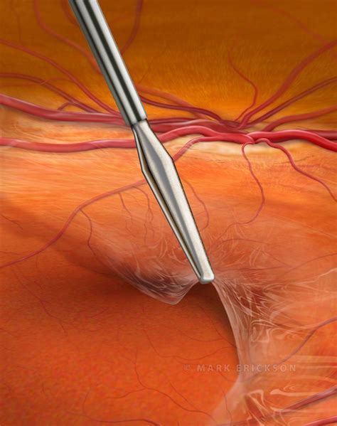 Epiretinal membrane peel, vitreoretinal surgery illustration