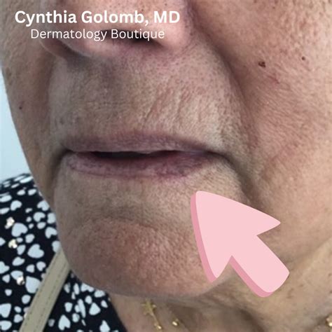 Venous Lake on Lip | Cynthia Golomb, MD | Dermatology Boutique