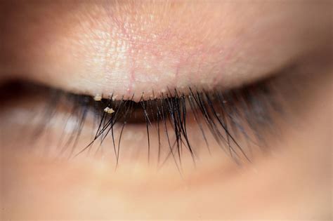 Demodex Blepharitis Symptoms, Causes, and Treatment Explained