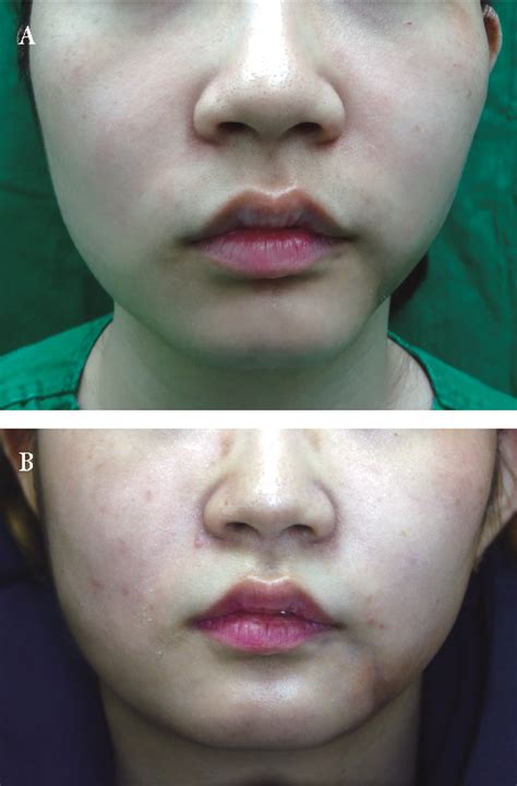 Figure 2 from Surgical Management of Localized Scleroderma | Semantic Scholar