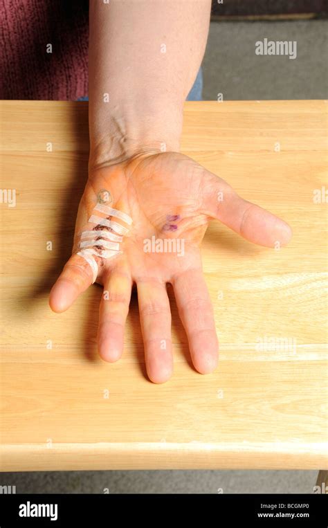 Dupuytren Contracture Pictures Dupuytren Contracture