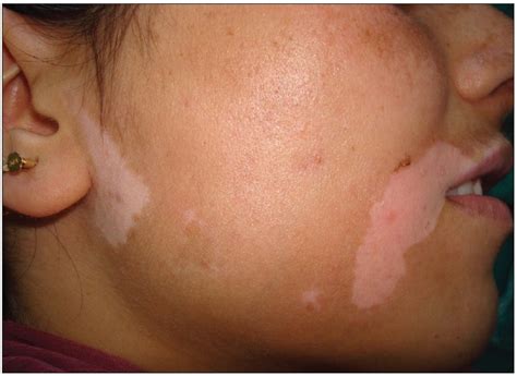 Preoperative picture of vitiligo lesions on face | Download Scientific Diagram
