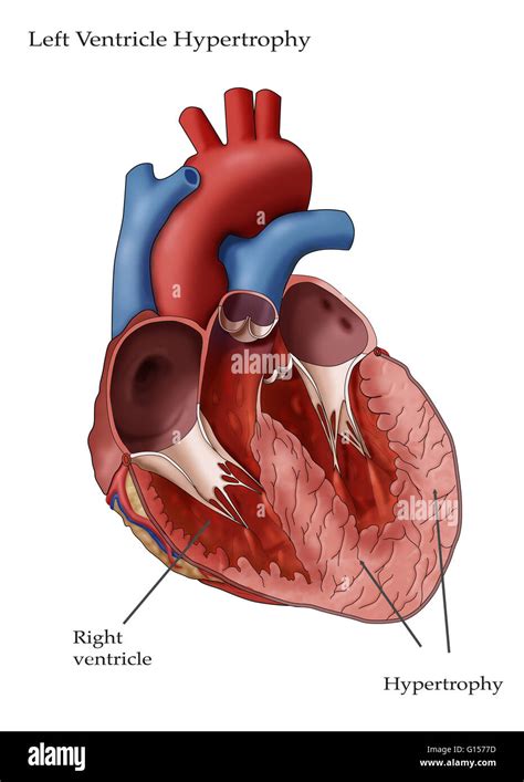 Left Ventricular Hypertrophy