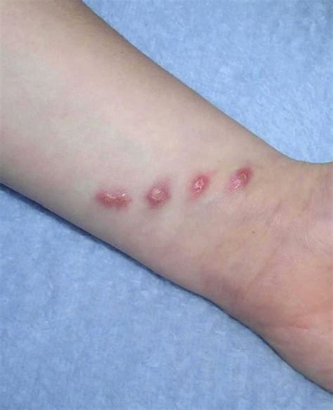 Rash Cat Scratch Disease at Antoinette Gonzalez blog