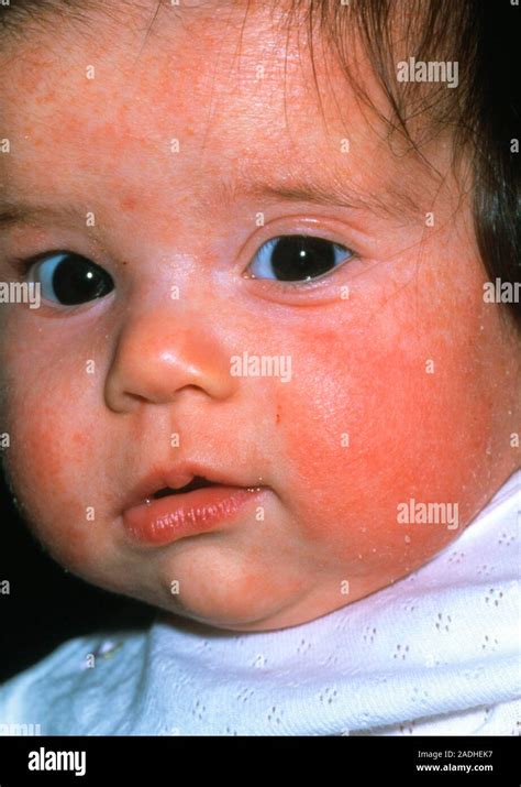 Atopic eczema on the face of a 3- month-old baby girl. The skin is red and scaly. Atopic eczema ...