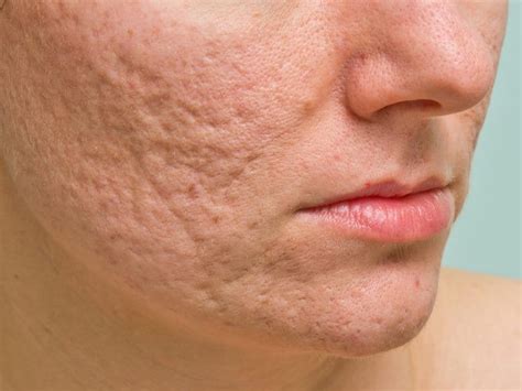 Acne Scar Removal Treatments - Cambridge Therapeutics