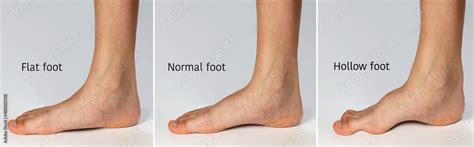 Chart showing forms of foot. Flat shape( fallen arch), Normal healthy foot and hollow shape ...