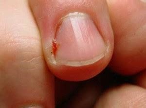 Hangnail Infection | Good Health