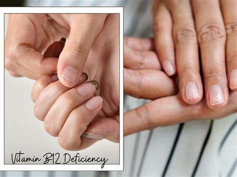 10 Vitamin B12 Deficiency Symptoms That Appears On Nails