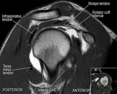 MRI Musculo-Skeletal Section: How to locate glenohumeral ligaments.