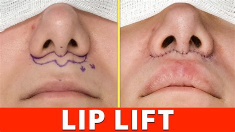 Lip Lift Full Procedure in 4K (Graphic) - YouTube