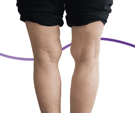 Knocked Knees (Genu Valgum): Causes, Symptoms & Treatment | The Feet People Podiatry