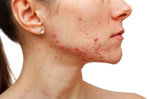 Hormonal Acne: What It Is, Causes, Treatments and Remedies