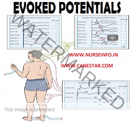 EVOKED POTENTIALS - Nurse Info