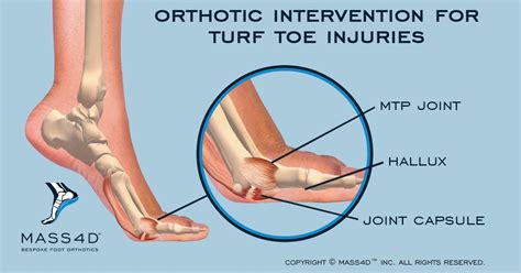 How An Orthotic Intervention Can Help Treat Turf Toe Injuries - MASS4D® Foot Orthotics