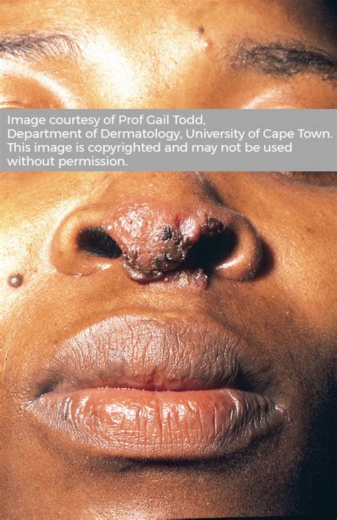 Cutaneous tuberculosis | Pathology Learning Centre