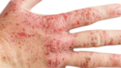 Is Eczema A Disability? | Accommodations + Benefits | Gladskin