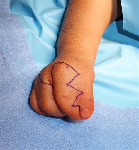 Thumb Index Syndactyly | Congenital Hand and Arm Differences ...